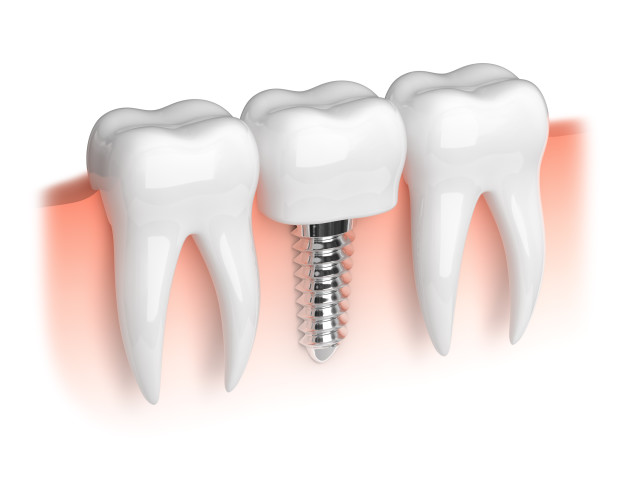 Dental Implants,dental implants in Newry, irish dental implants